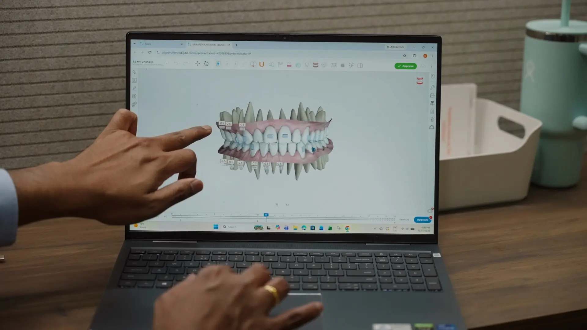 A 3D model of a full set of teeth on a laptop screen
